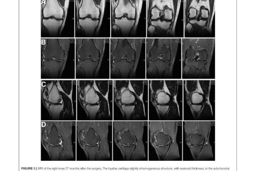 Cell technology used to treat osteochondral knee defect ,Republican Clinical Hospital, regenerative medicine, joint, IFMB, Gene and Cell Technologies Lab